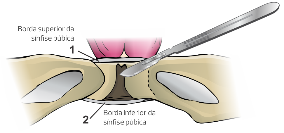 Sinfisiotomia