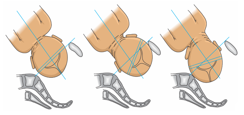 Sinclitismo, assinclitismos posterior (Litzman) e anterior (Nagele)