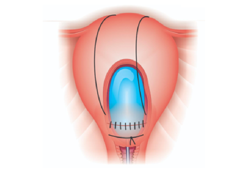 Técnica do sanduíche uterino