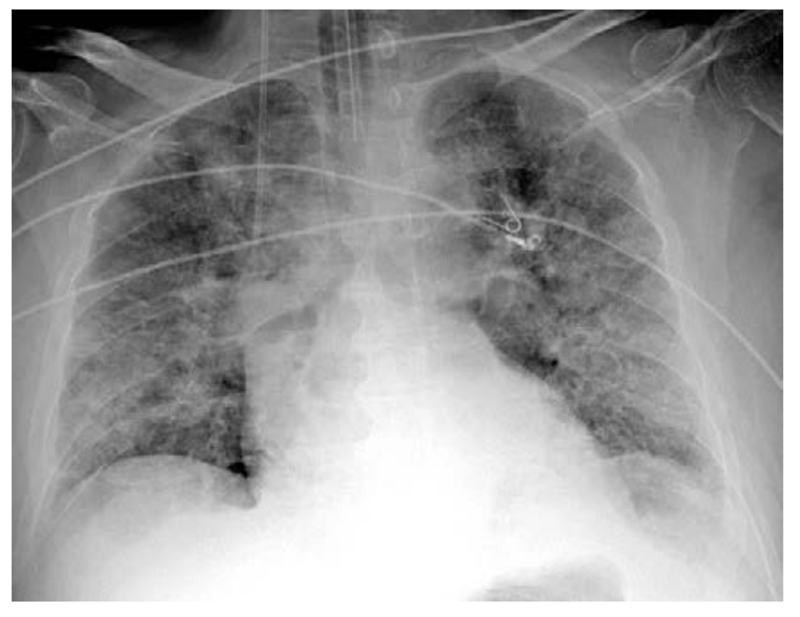Raio X do pulmão