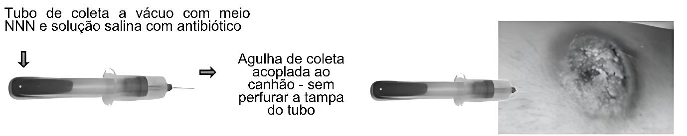 Esquema do procedimento de coleta de amostra clínica para diagnóstico de leishmaniose. À esquerda, há um tubo de coleta a vácuo contendo meio NNN e solução salina com antibiótico. No centro, a imagem mostra a agulha de coleta acoplada ao canhão, posicionada sobre o tubo sem perfurar sua tampa. À direita, fotografia em preto e branco de uma lesão cutânea ulcerada na pele, que representa o possível local da coleta da amostra. Fonte: Figura 23. Procedimento de coleta de amostra clínica para diagnóstico de leishmaniose.​