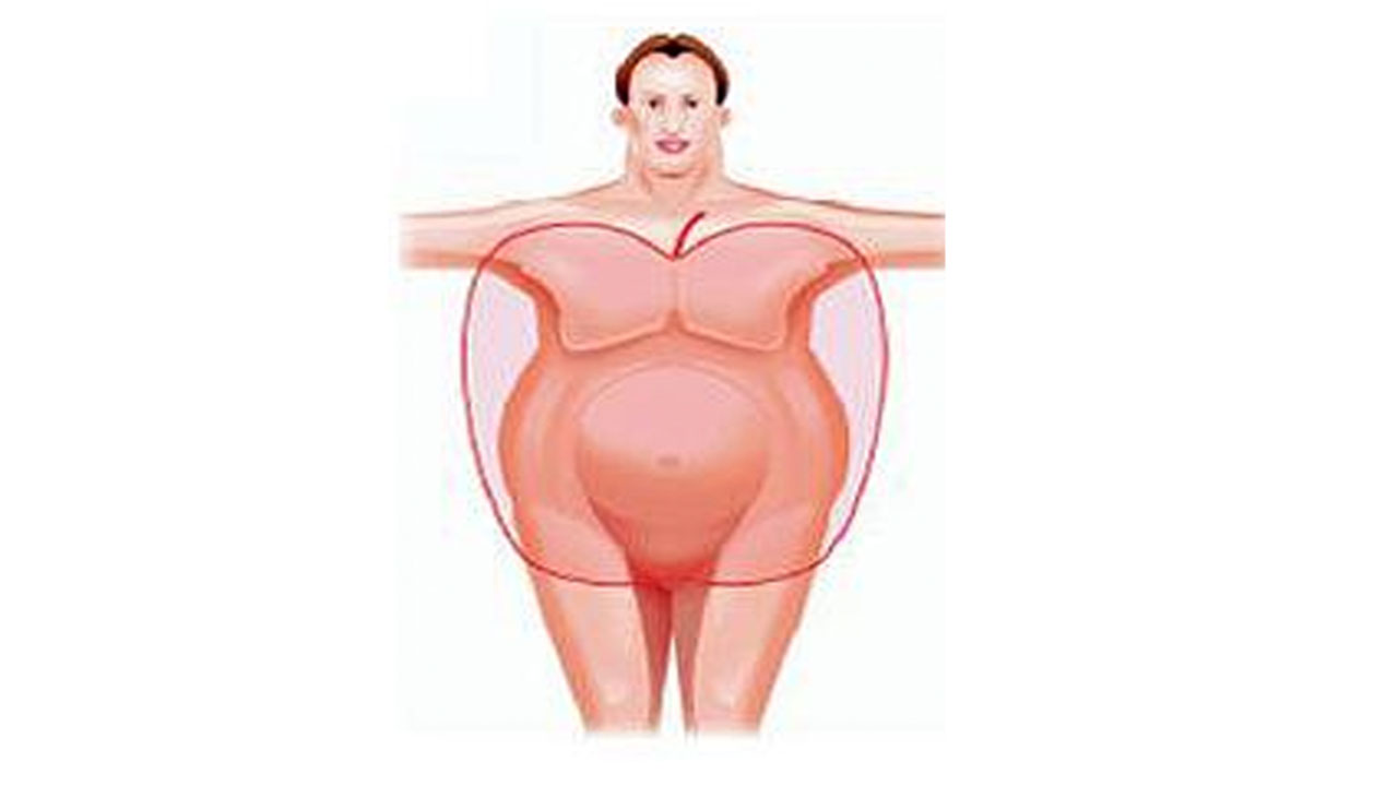 Imagem ilustrativa da obesidade androide, também conhecida como obesidade central, a gordura localiza-se principalmente na parte superior do corpo (gordura visceral). Há uma imagem ilustrativa de uma mulher e sobre o corpo o desenho de uma maçã, mostrando que o formato do corpo está na forma de uma maçã.