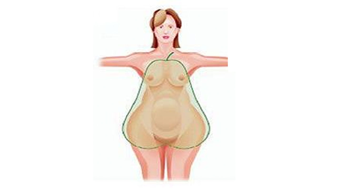 Imagem ilustrativa da obesidade ginecóide, também conhecida como obesidade periférica, na qual a gordura localiza-se principalmente na parte inferior do corpo, quadril, nádegas e coxas, sobre o corpo a forma de uma pera.