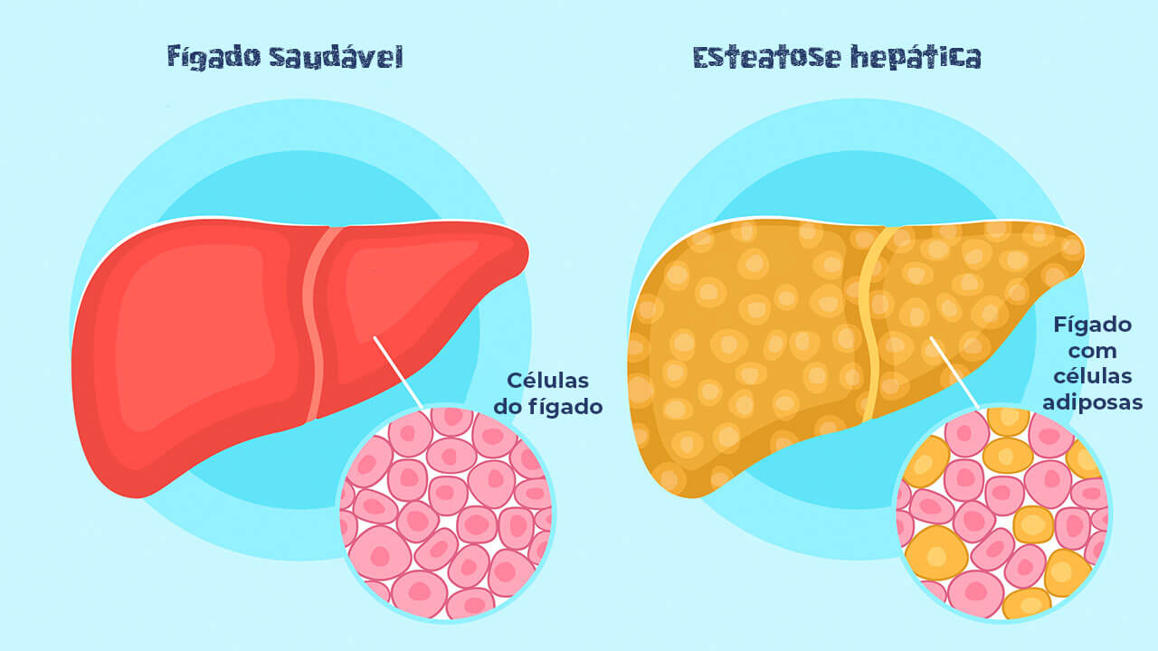 Imagem ilustrativa de dois fígados, o primeiro é um fígado saudável e de cor vermelha, e há um destaque para as suas células também, o segundo é um fígado com Esteatose hepática, em uma cor amarela, e há um destaque para as células adiposas.