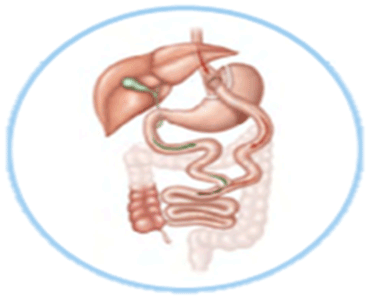 Bypass gástrico, o cirurgião reduz o espaço para o alimento no estômago. Ao mesmo tempo, faz um desvio no intestino que aumenta a sua produção de hormônios da saciedade. Ao ingerir menos comida e se sentir mais saciada, a pessoa emagrece. 