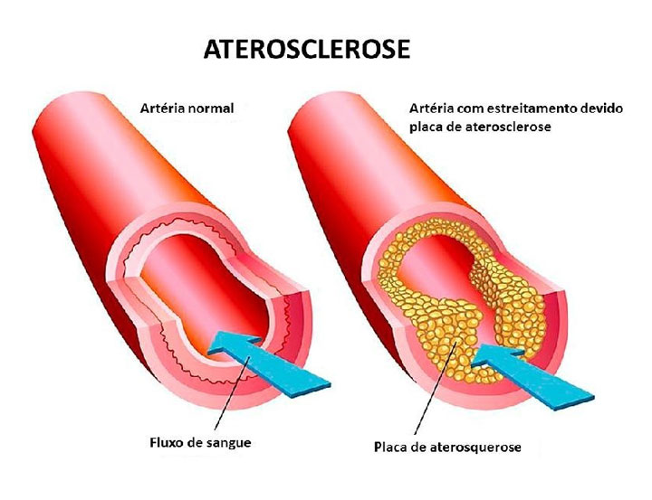 Esquema ilustrando uma artéria normal e outra artéria acometida de estreitamento (estenose) devido a presença de uma placa de aterosclerose, na figura ilustrativa a primeira artéria está com o fluxo de sangue liberado, a segunda está com a placa de aterosclerose, está ilustrada com várias bolinhas amarelas que impossibilitam a passagem de sangue.