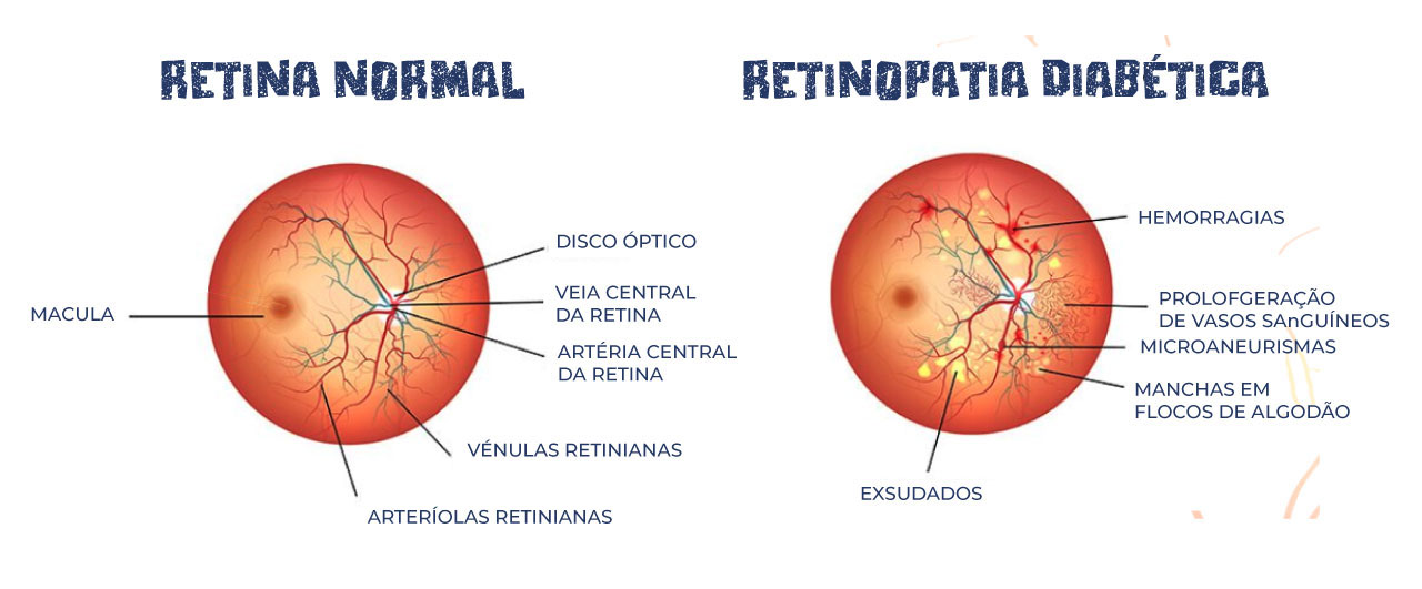 Fonte : Adaptado e traduzido de Fonte: Eye Center of Hawaii - Diabetic Retinopathy