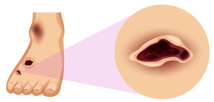 Figura ilustrativa de um pé diabético, o pé está com uma mancha e machucados, um dos machucados está detalhado, uma abertura avermelhada na pele.