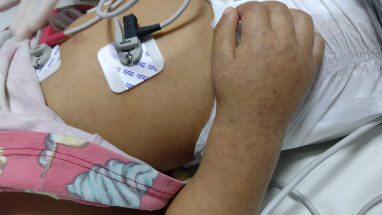  Imagem de exantema da febre maculosa brasileira em criança do sexo feminino, de 2 anos. É possível observar o intenso edema na mão direita.  Crédito da foto: Dra Cláudia Toledo.