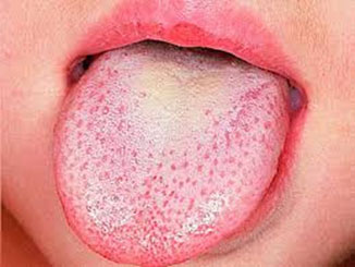 Fotografia com enfoque em uma boca infantil, com língua à mostra e lesões de candidíase em sua superfície. A língua tem uma cor esbranquiçada, com pequenos pontos avermelhados, e uma região mais amarelada ao centro. 