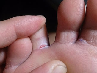 Fotografia de pele da sola do pé com lesão em região dos dedos. É uma lesão decorrente de micose, conhecida também pelo nome de pé de atleta.
