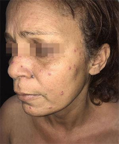 Fotografia da face de uma pessoa parda, com lesões esparsas em toda a região do rosto: nariz, queixo e bochechas. As lesões são acneiformes e pápulas eritematosas – avermelhadas.