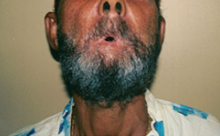 Fotografia da face de um homem pardo, que usa barba e bigode e apresenta sequela com restrição da abertura da boca/ lábios em decorrência de paracoccidioidomicose.