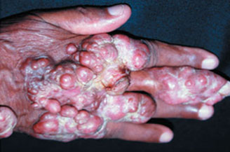 Fotografia de região de mão de uma pessoa negra com lesões, verrugas e e nódulos arroxeados e avermelhados em toda a extensão do dorso do membro e dedos.