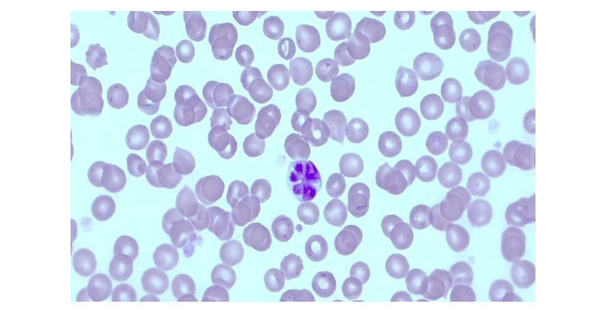 Imagem mostra uma foto histológica representativa da Flower Cell em sangue periférico, com células com núcleo irregular, semelhante a uma flor com várias pétalas.