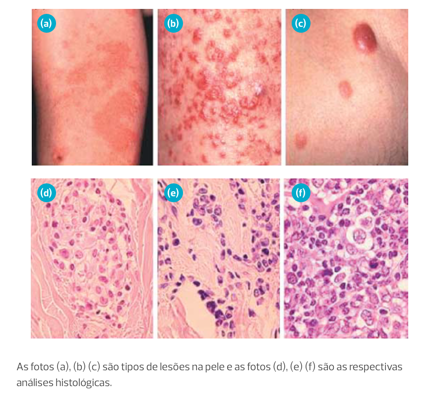 A imagem tem seis fotos. As três primeiras são fotos de lesões na pele e as três seguintes são as respectivas análises histológicas.