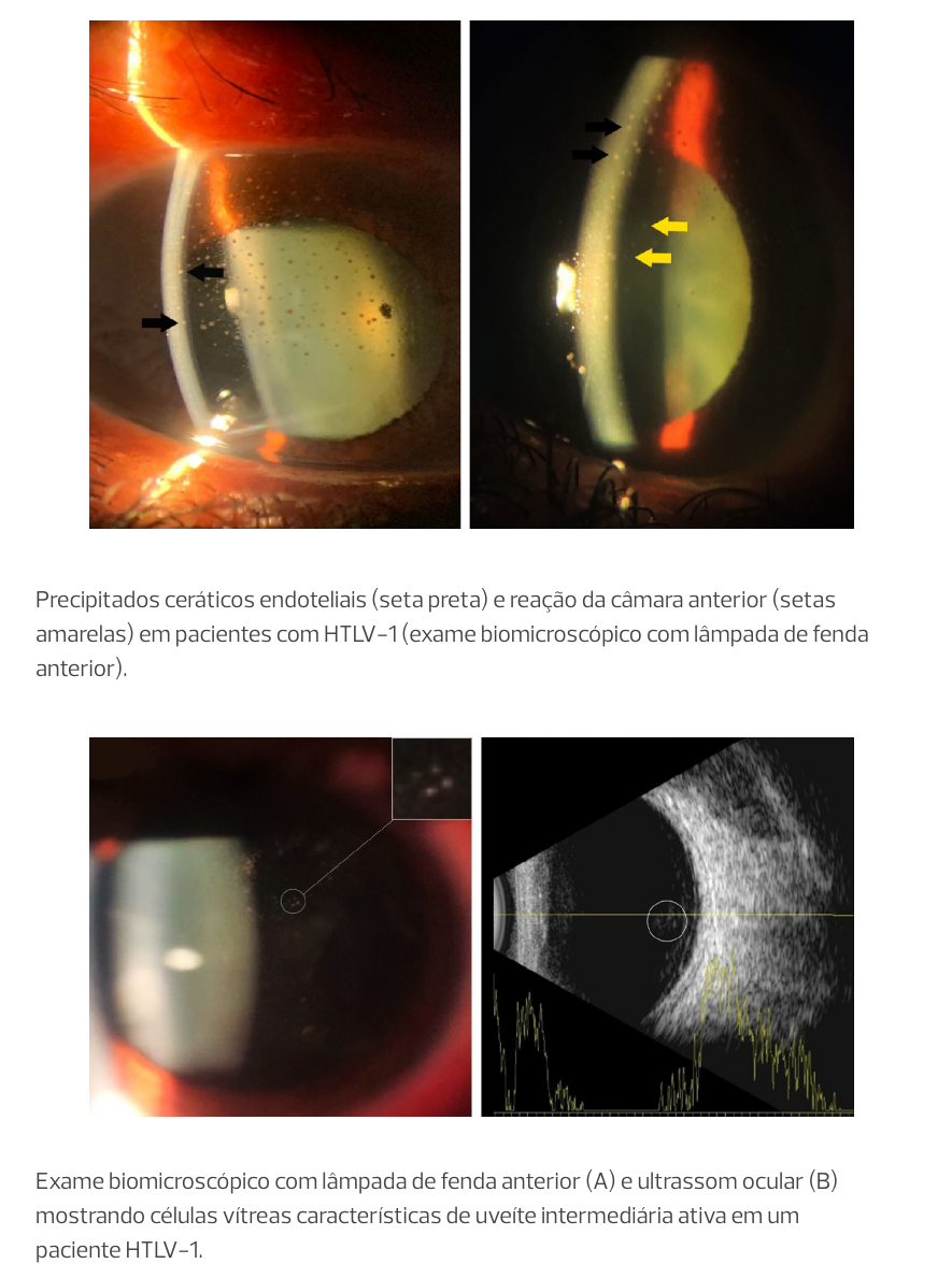 Sequência de quatro foto. As duas primeiras mostram precipitados ceráticos endoteliais e a reação da câmara anterior em pacientes com HTLV-1 no exame biomicroscópico com lâmpada de fenda anterior. As duas fotos seguintes mostram um exame biomicroscópico com lâmpada de fenda anterior e ultrassom ocular mostrando células vitreas, características de uveite intermediária ativa em um paciente HTLV-1.