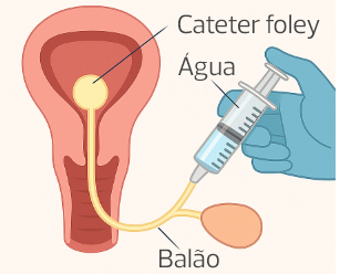 Cateter